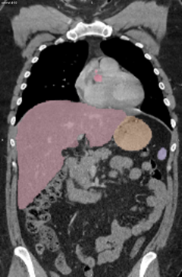Coronal CT slice with segmented organs