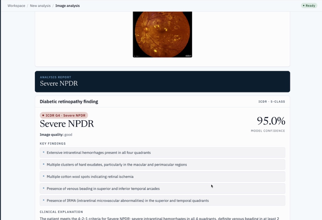 OphScan report showing Severe NPDR at 95 percent confidence