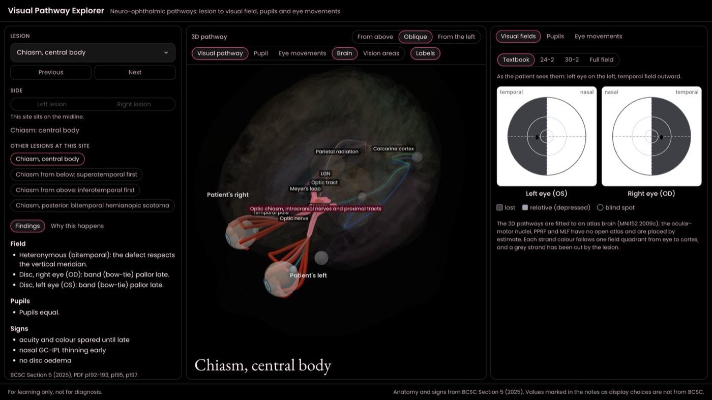 Explorer showing a central chiasm lesion with bitemporal fields