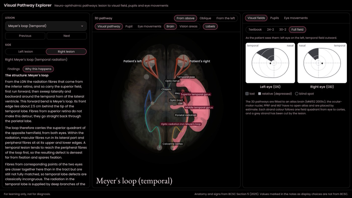 Explorer showing a right Meyer's loop lesion seen from above